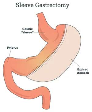 stomach sleeve graphic