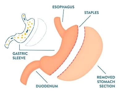 gastric sleeve graphic